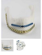 頜面修復(fù)接骨板