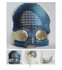 頜面修復(fù)鈦網(wǎng)