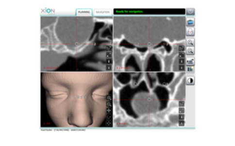 內窺鏡投射技術